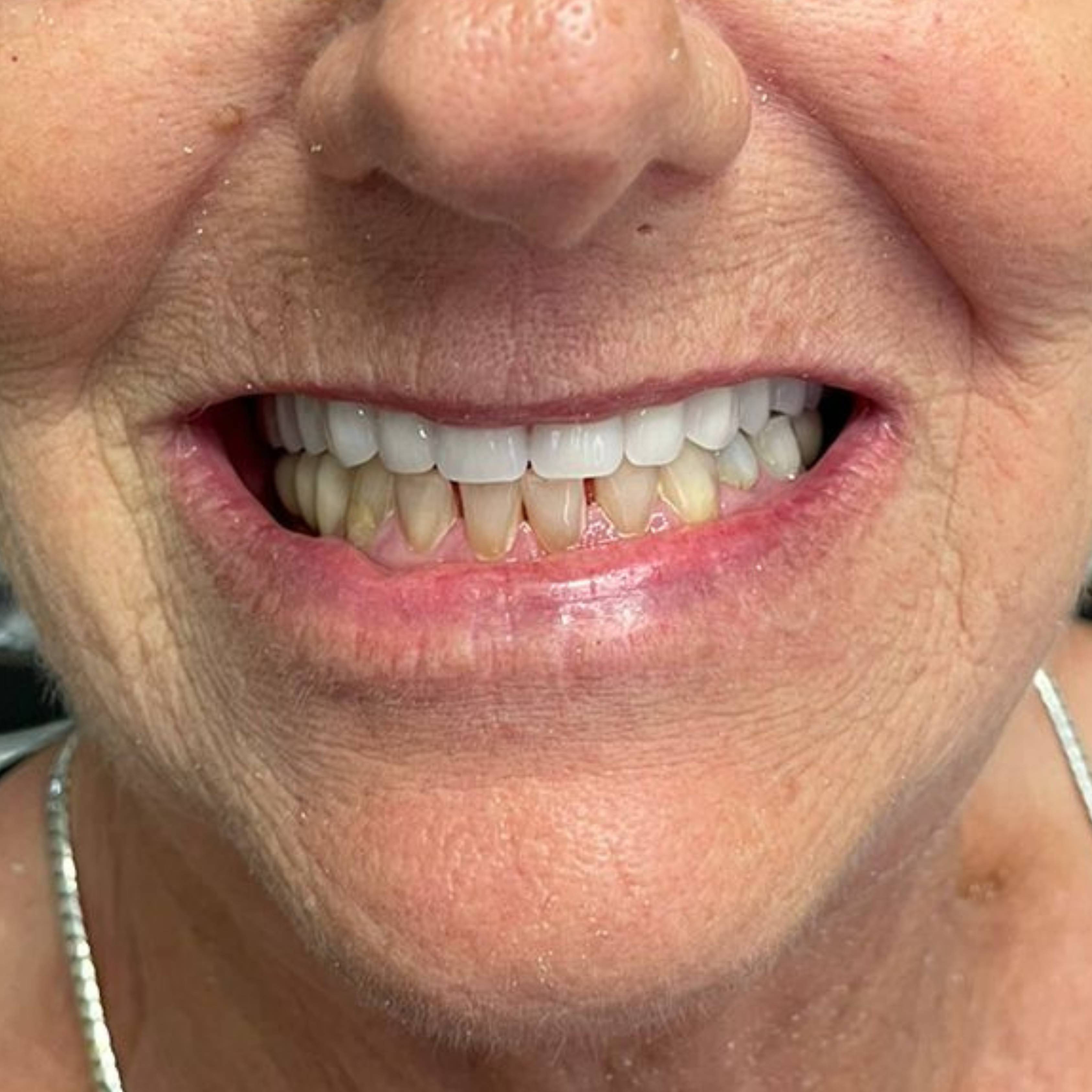 Resultado de tratamento - Sorriso restaurado